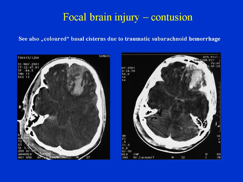 Focal brain injury – contusion  See also „coloured“ basal cisterns due to traumatic